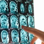anaheim brain injury lawyer